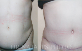 TUMMYTUCK