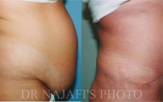 TUMMYTUCK