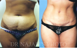 TUMMYTUCK