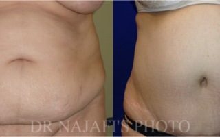 TUMMYTUCK