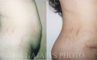 TUMMYTUCK