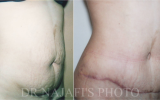 TUMMYTUCK