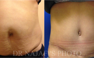 TUMMYTUCK