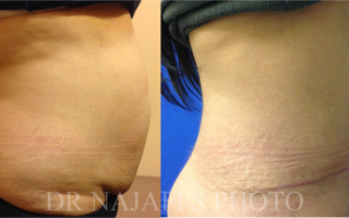 TUMMYTUCK