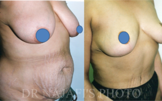 TUMMYTUCK