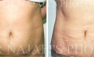 Liposuction
