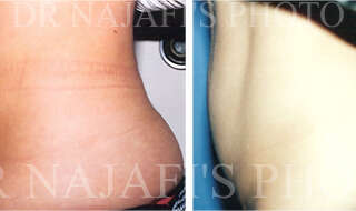 Liposuction