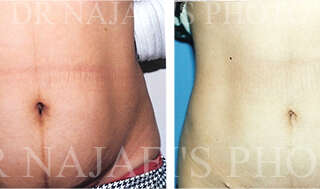 Liposuction