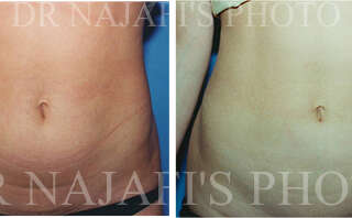 Liposuction