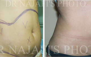 Liposuction
