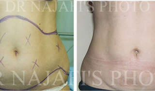 Liposuction