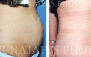 Liposuction