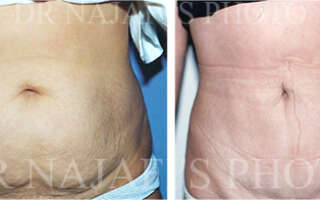 Liposuction