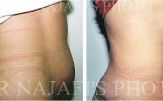 Liposuction