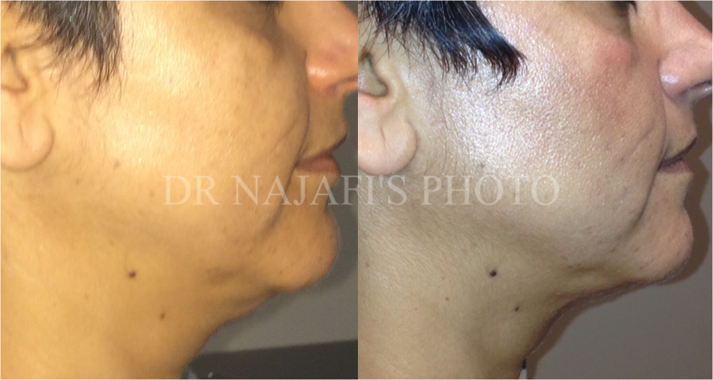 https://www.drhosseinnajafi.com/wp-content/uploads/2016/05/FACE9-1024x547.png
