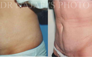TUMMYTUCK